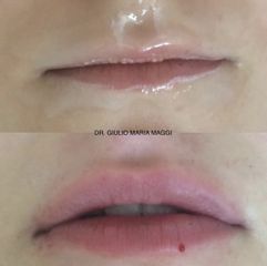 Filler labbra - Aesthetic Clinic del Dott. Giulio Maria Maggi