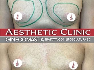 Ginecomastia prima e dopo - 877553