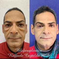 Blefaroplastica - Dott. Raffaele Castaldo