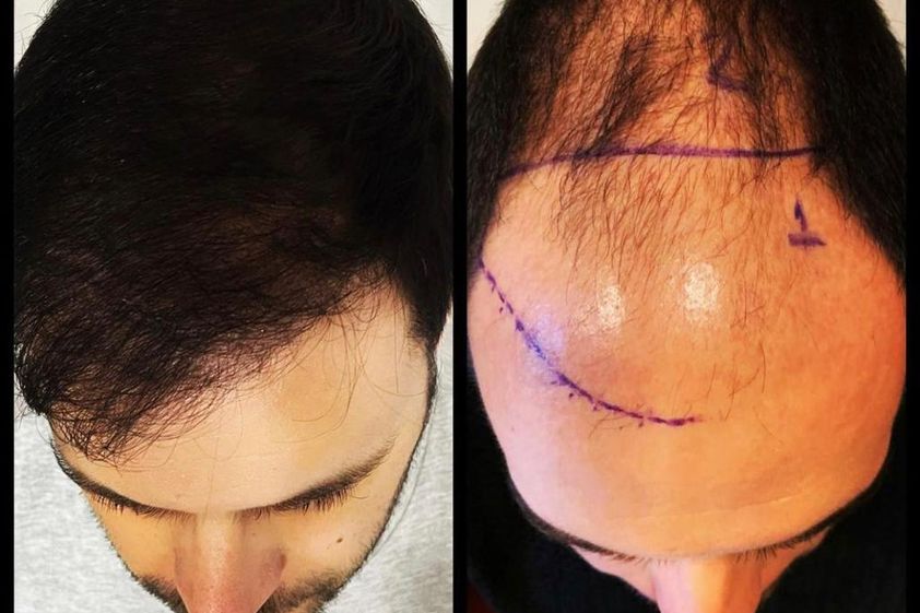 Trapianto capelli prima e dopo - 800976