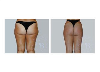 Liposcultura prima e dopo
