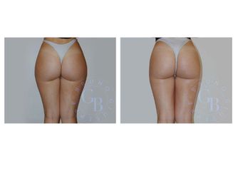 Glutei prima e dopo