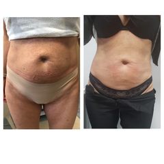 Liposuzione prima e dopo