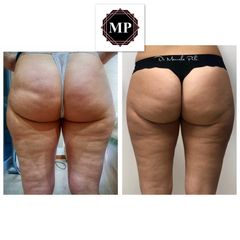 Cellulite prima e dopo
