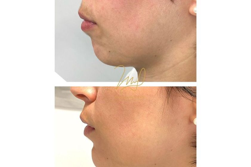 Mentoplastica prima e dopo - 818820