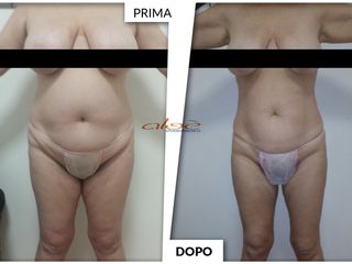 Dimagrimento prima dopo