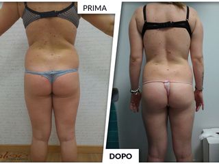 Dimagrimento prima dopo