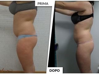 Dimagrimento prima dopo
