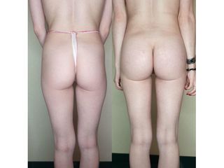 Gluteoplastica prima e dopo