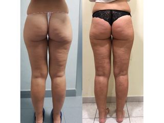 Liposuzione prima e dopo