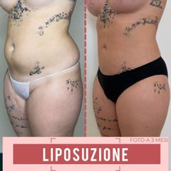 Liposuzione - Mec Broker