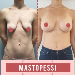 Mastopessi - Mec Broker