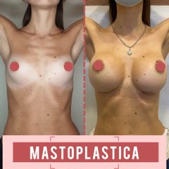 Mastoplastica additiva - Mec broker