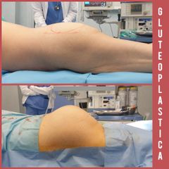 Gluteoplastica - The Swiss Clinic