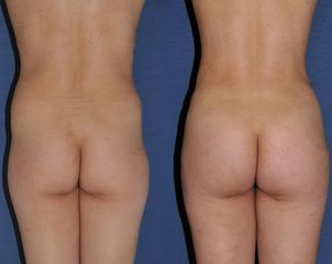 Liposcultura Glutei prima dopo