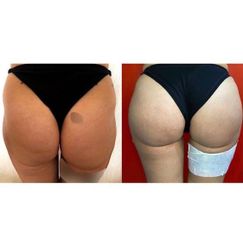 Gluteoplastica - Dott. Arturo Amoroso