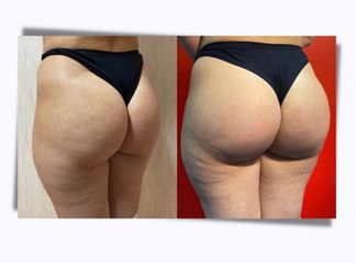 Gluteoplastica - Dott. Arturo Amoroso