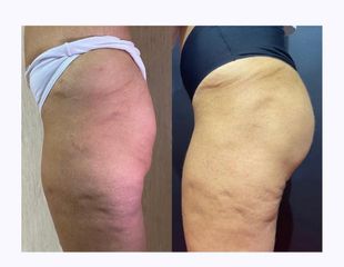 Gluteoplastica - Dott. Arturo Amoroso