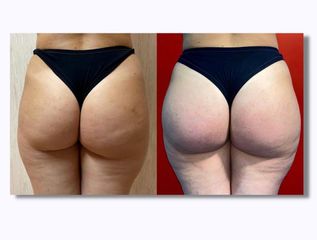 Gluteoplastica - Dott. Arturo Amoroso