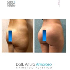 Gluteoplastica - Dott. Arturo Amoroso