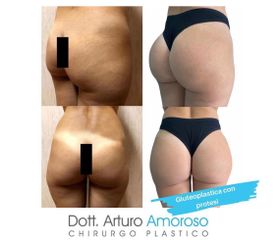 Gluteoplastica - Dott. Arturo Amoroso