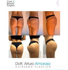 Gluteoplastica - Dott. Arturo Amoroso