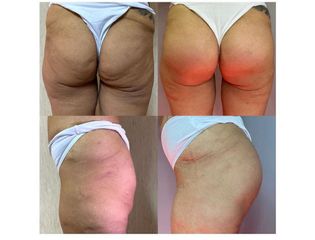 Gluteoplastica - Dott. Arturo Amoroso