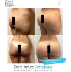 Gluteoplastica - Dott. Arturo Amoroso