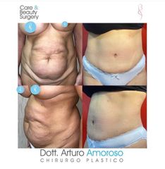 Addominoplastica - Dott. Arturo Amoroso