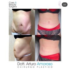 Addominoplastica - Dott. Arturo Amoroso