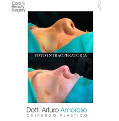 Rinoplastica - Dott. Arturo Amoroso
