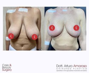Mastoplastica riduttiva - Dott. Arturo Amoroso