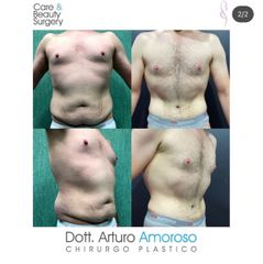 Liposuzione - Dott. Arturo Amoroso