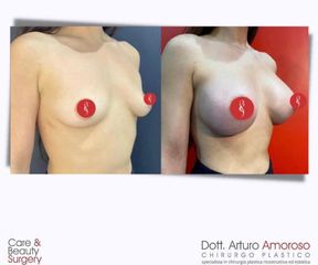 Mastoplastica additiva - Dott. Arturo Amoroso