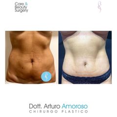 Addominoplastica - Dott. Arturo Amoroso