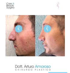 Rinoplastica - Dott. Arturo Amoroso