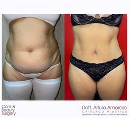 Addominoplastica - Dott. Arturo Amoroso