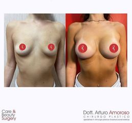 Mastoplastica additiva - Dott. Arturo Amoroso