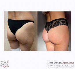 Gluteoplastica - Dott. Arturo Amoroso