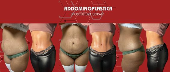 Dottor Arturo Amoroso Addominoplastica e liposcultura