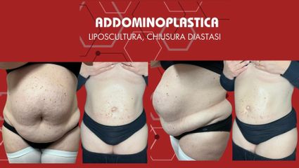 Dott. Arturo Amoroso Addominoplastica