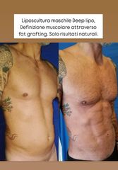 Dott. Arturo Amoroso Liposcultura