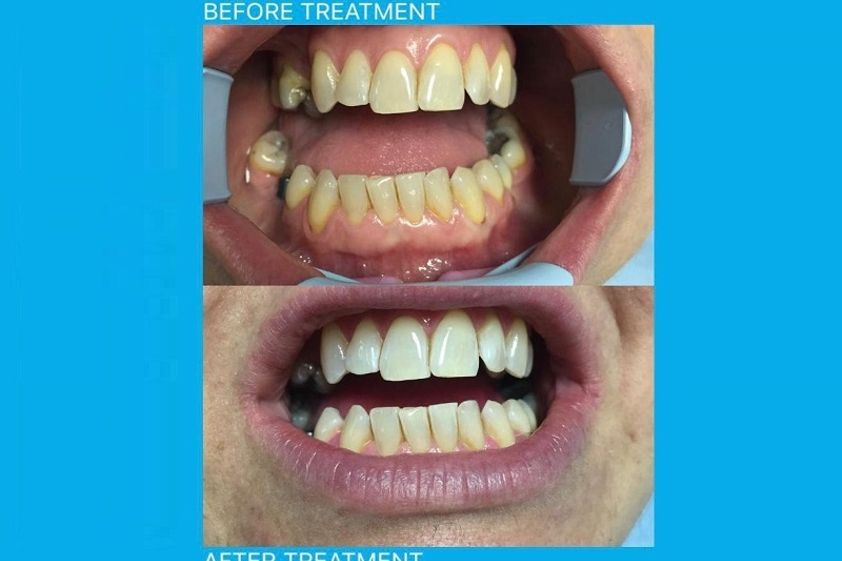 Faccette dentali prima e dopo - 766510