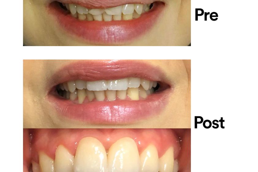 Faccette dentali prima e dopo - 769412
