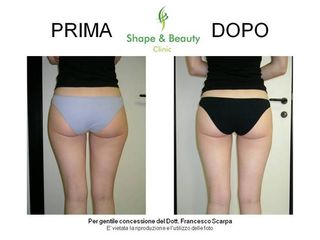 Pre e post microlipocavitazione