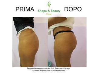 Prima e dopo Gluteoplastica