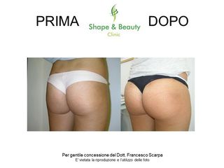 Prima e dopo Gluteoplastica