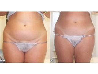 Cavitazione medica prima e dopo