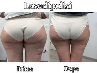 Laserlipolisi prima dopo