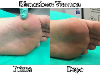 verruca prima dopo